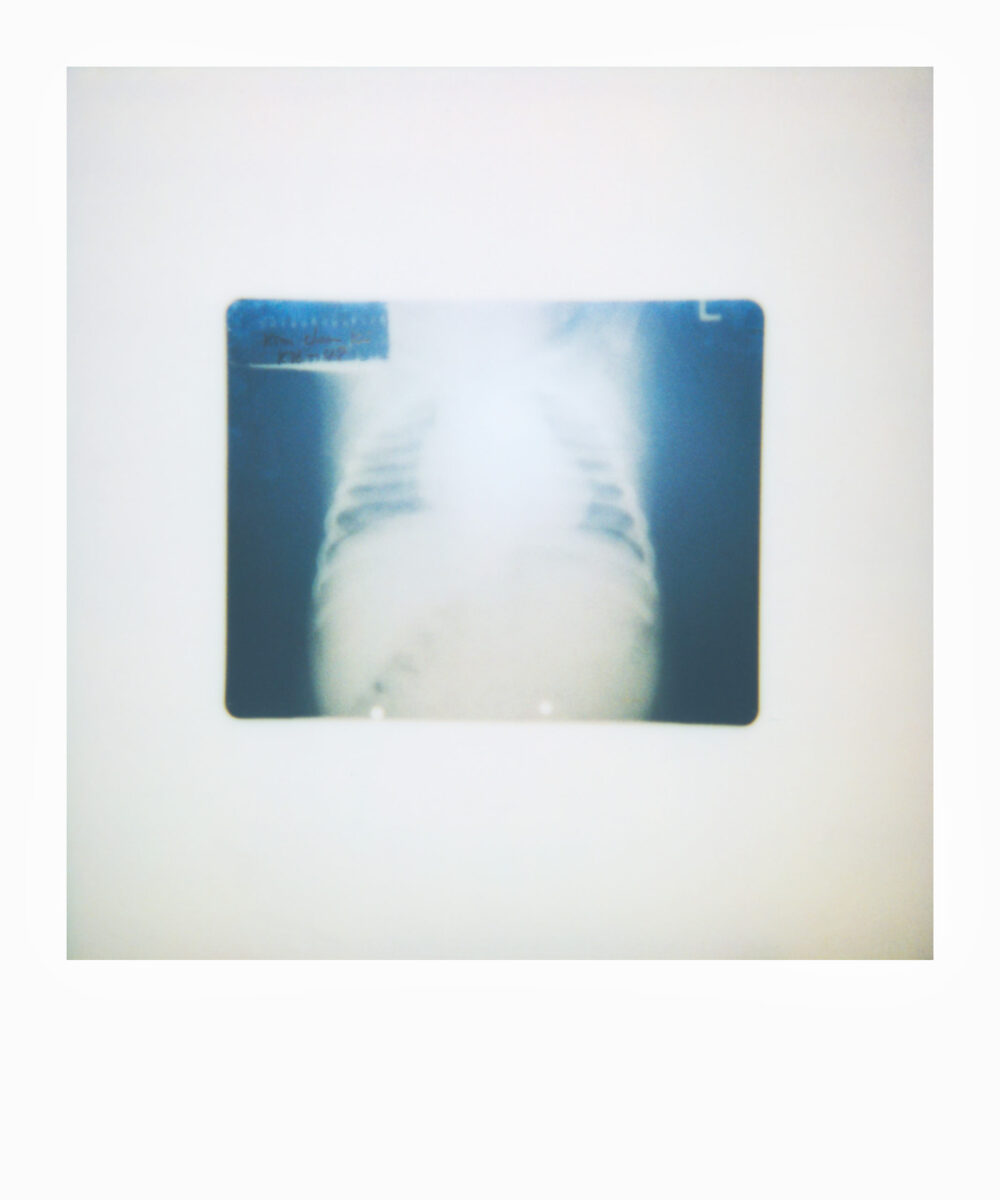 oversized Polaroid of a chest x-ray
